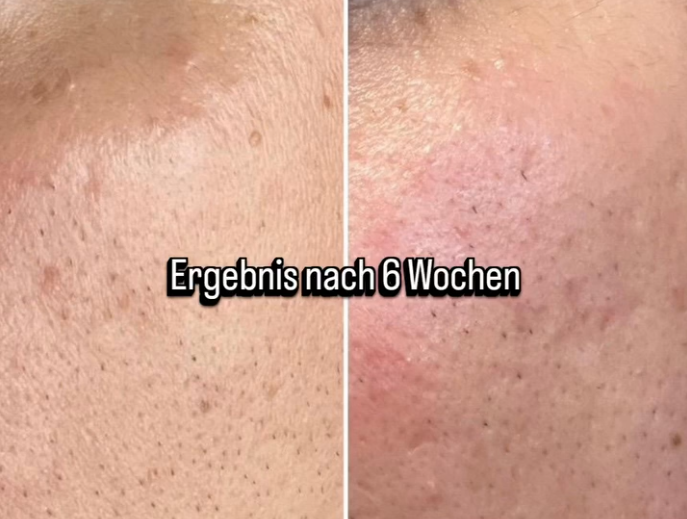 Hautverbesserung in 6 Wochen – Die Hautreise meines Mannes